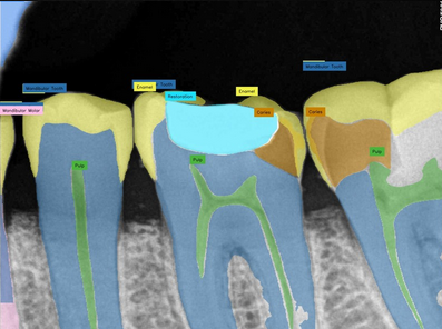 Dental X-ray after epikdoc Xray IQ AI analysis — detected pathology highlighted