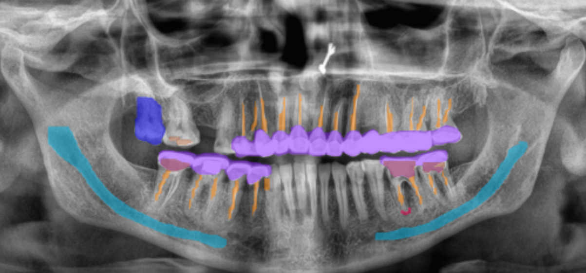 Dental X-ray after epikdoc Xray IQ AI analysis — detected pathology highlighted